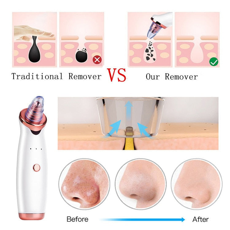 Facial Vacuum Blackhead & Acne Remover